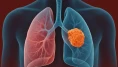Akciğer Kanseri: Sessiz Başlayan, Ölümcül Seyreden Tehlike