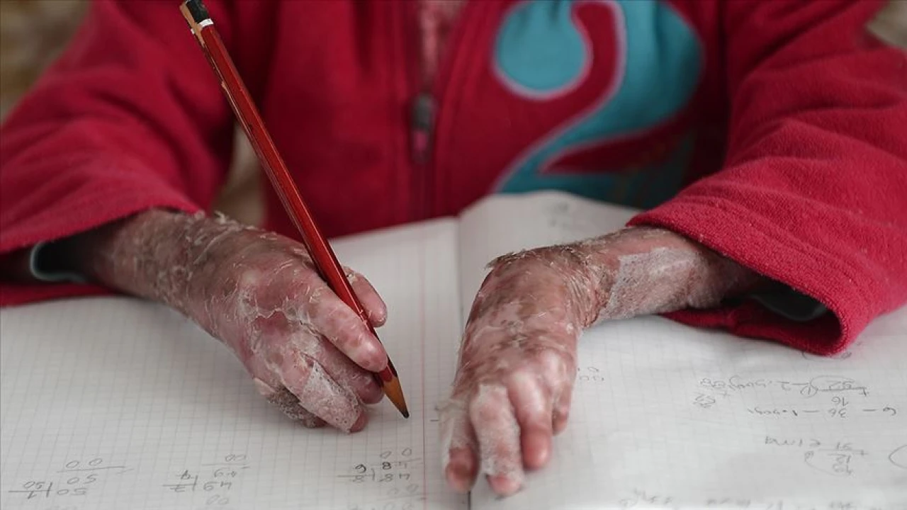 Kelebek Hastalığı Nedir, Neden Olur, Belirtileri Neler, Tedavisi Nasıl Yapılır?