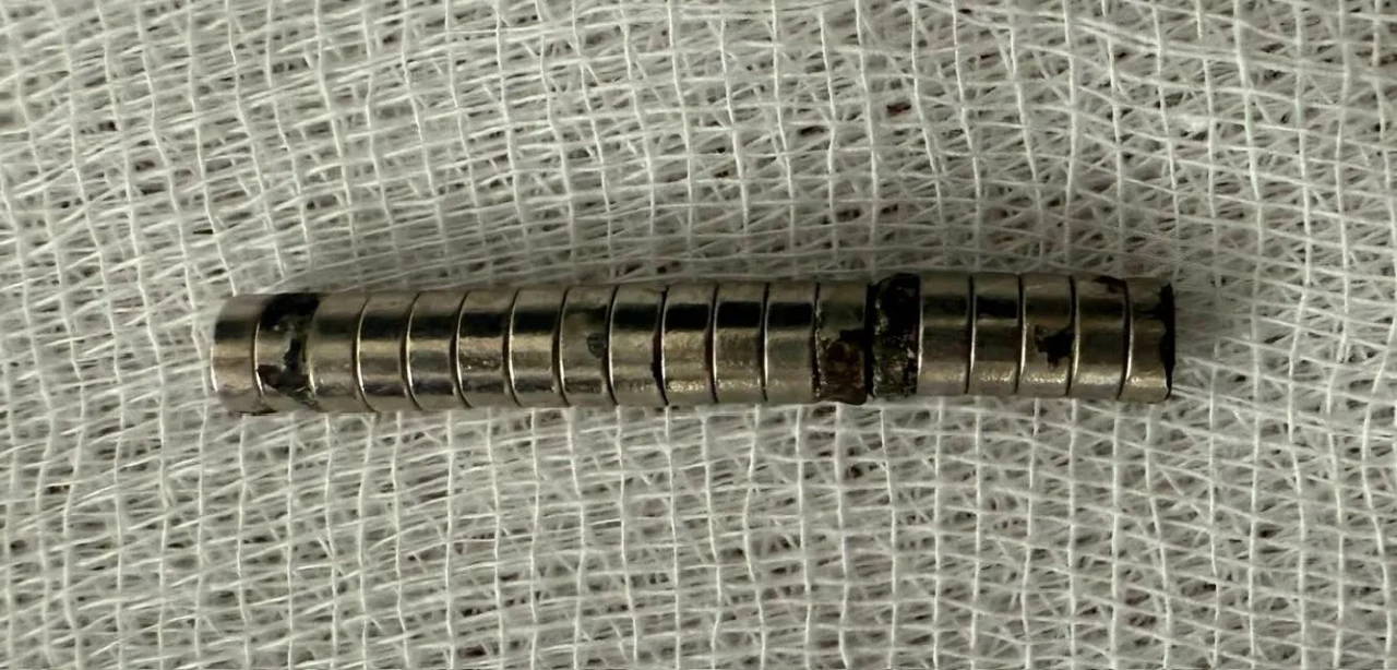 Doktorlar şaştı: Küçük çocuğun boğazından 19 mıknatıs çıkarıldı!