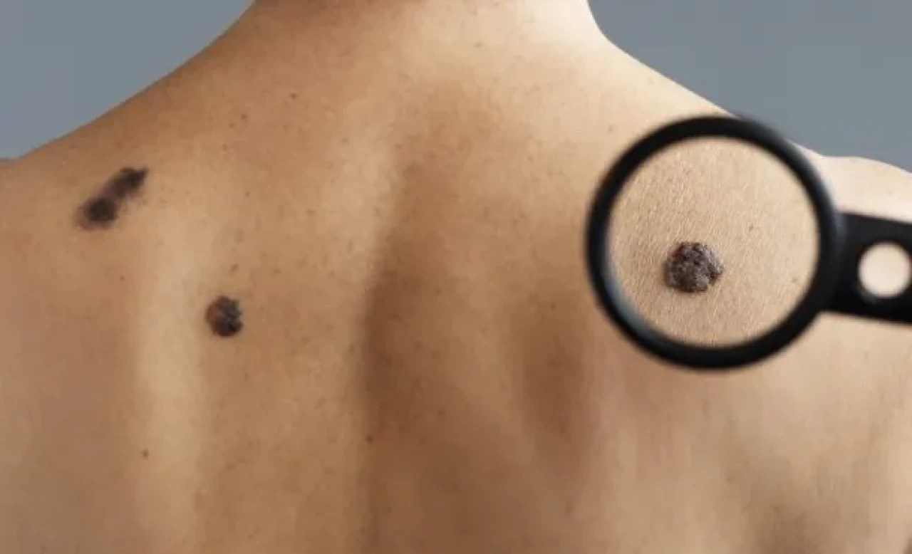 Sessiz Tehlike: Melanom Cilt Kanseri Sizi Fark Etmeden Öldürebilir! Melanom Nedir, Büyüme Hızı Ne Kadardır, Ağrı Yapar mı, Belirtileri Nelerdir?
