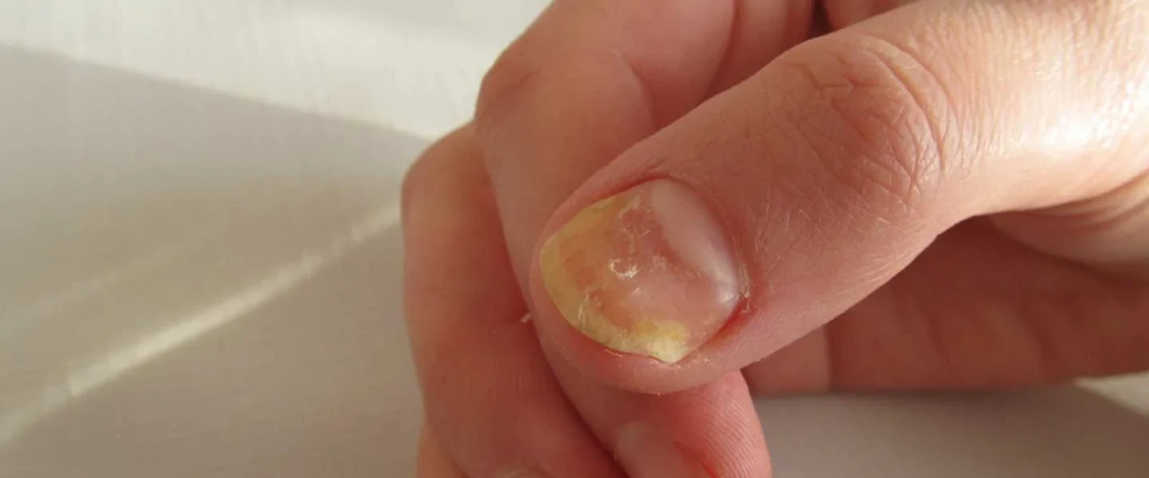 Ayak Sağlığınızı Tehdit Eden Tırnak Mantarı! Tedavisi ve Önleme Yöntemleri