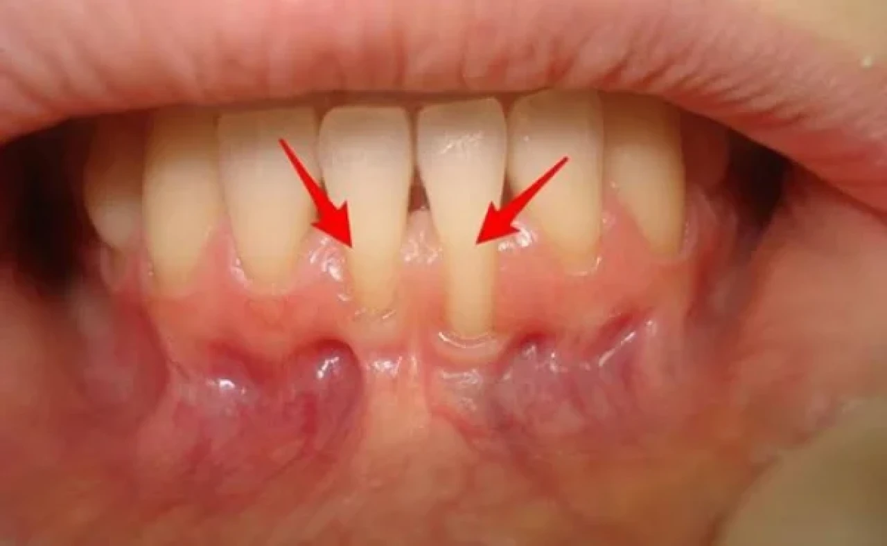 Diş Eti Çekilmesi Önlenebilir! Bu Adımları Takip Edin!