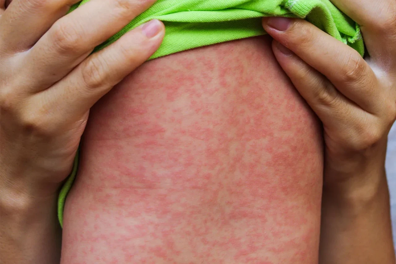 Avrupa ve Orta Asya’da Kızamık Vakaları Artıyor: Türkiye’de Durum Kontrol Altında mı?