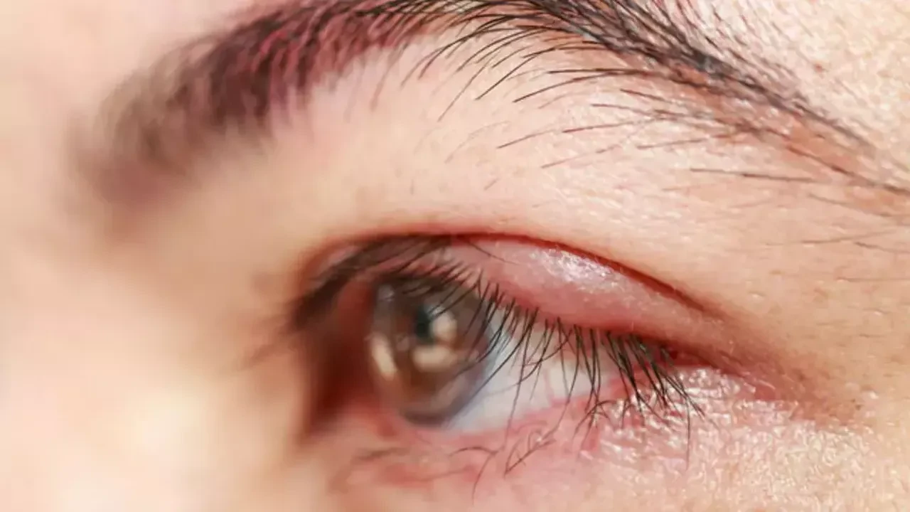 Göz Kapaklarınız Sürekli Kızarıyorsa Bu Hastalık Sessizce Yaklaşıyor Olabilir!