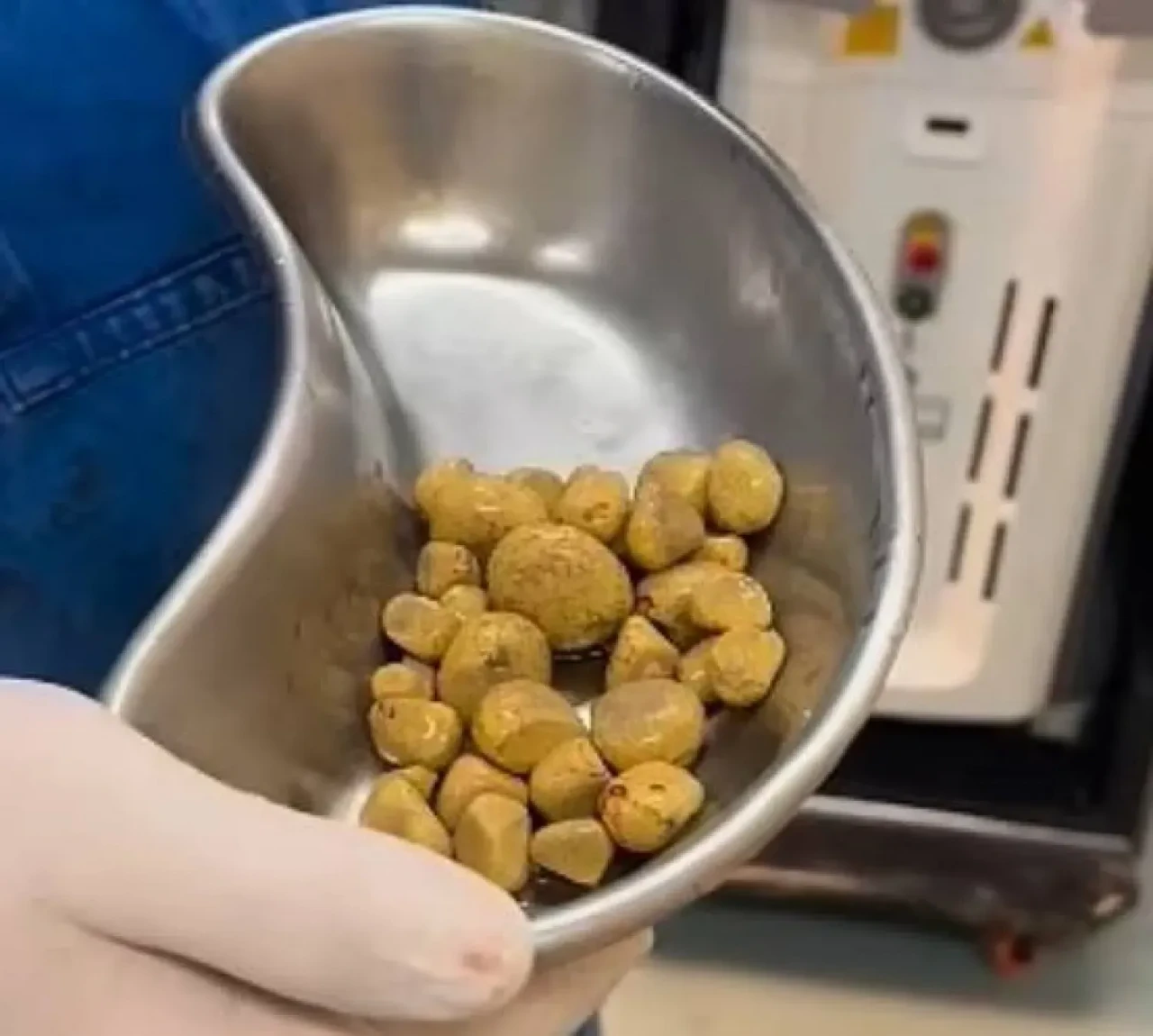 Ürolog Uyardı: Gazlı İçecekler Ameliyatla Bitebilir