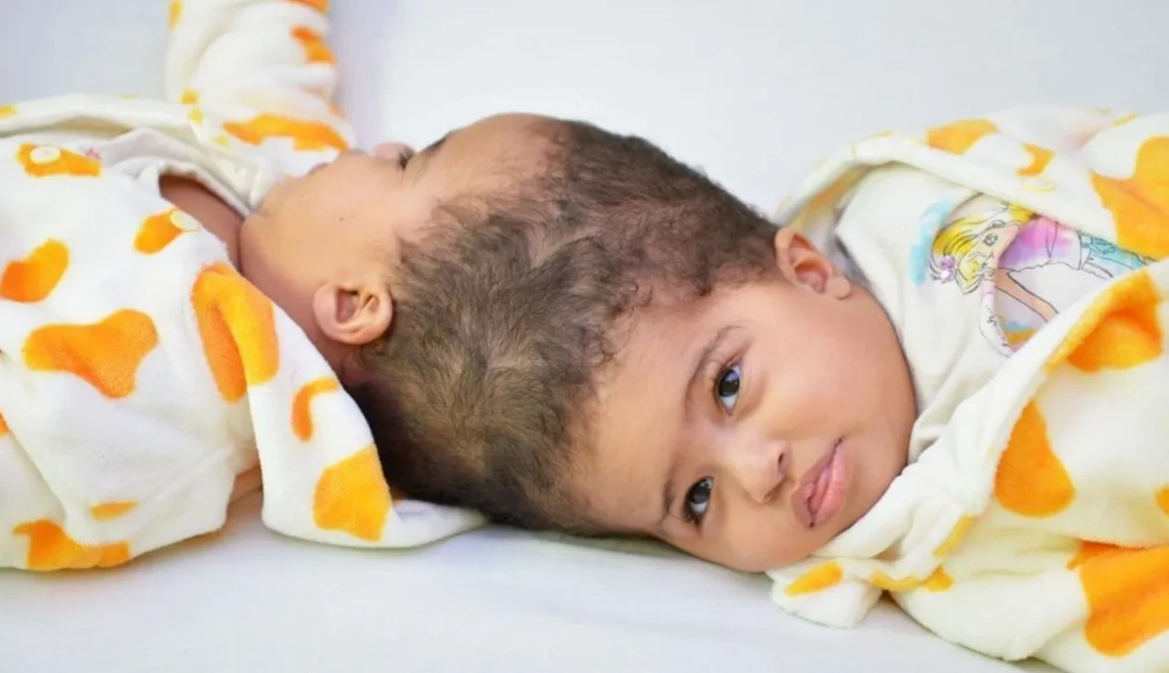 Dünya Nefesini Tuttu! Eritreli Siyam İkizleri Ayrıldı