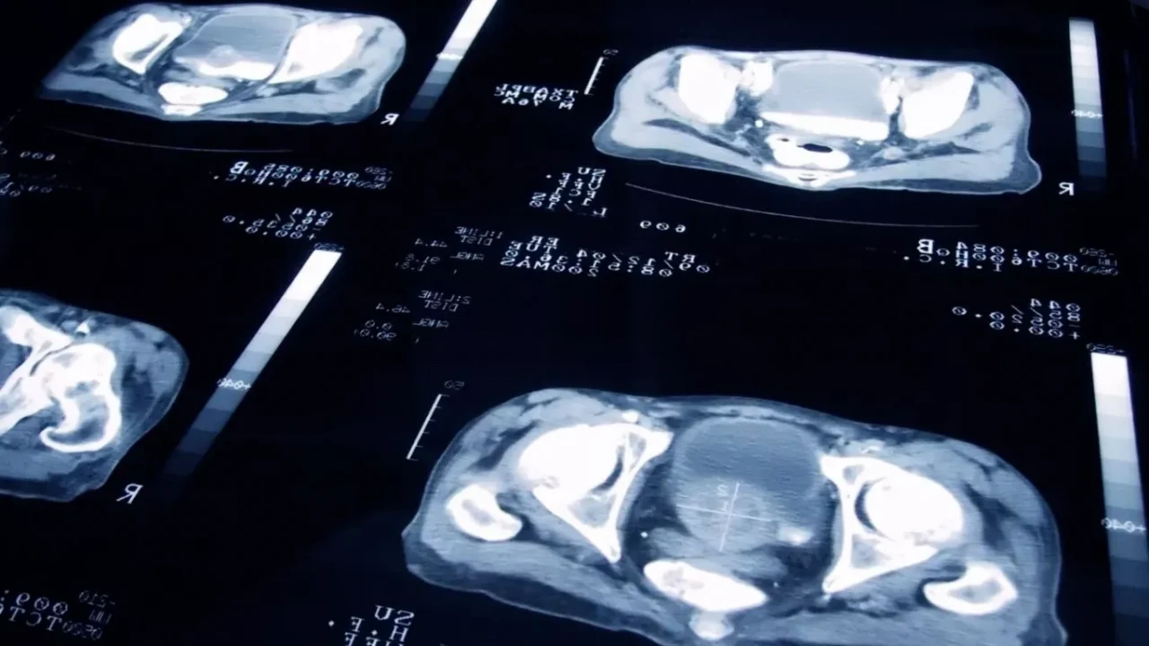 Yapay zeka hangi prostat kanseri hastasının ilaca yanıt vereceğini gösteriyor