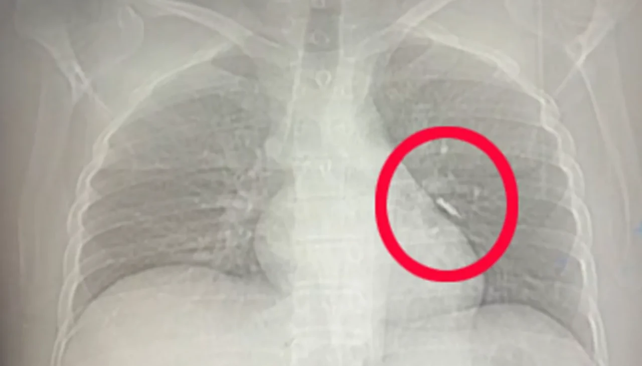 Diş tedavisinde vida akciğere saplandı, hayatı öksürükle kurtuldu