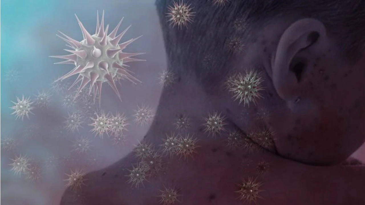 Kızamık salgını Endonezya'yı vurdu: 17 çocuk yaşamını yitirdi