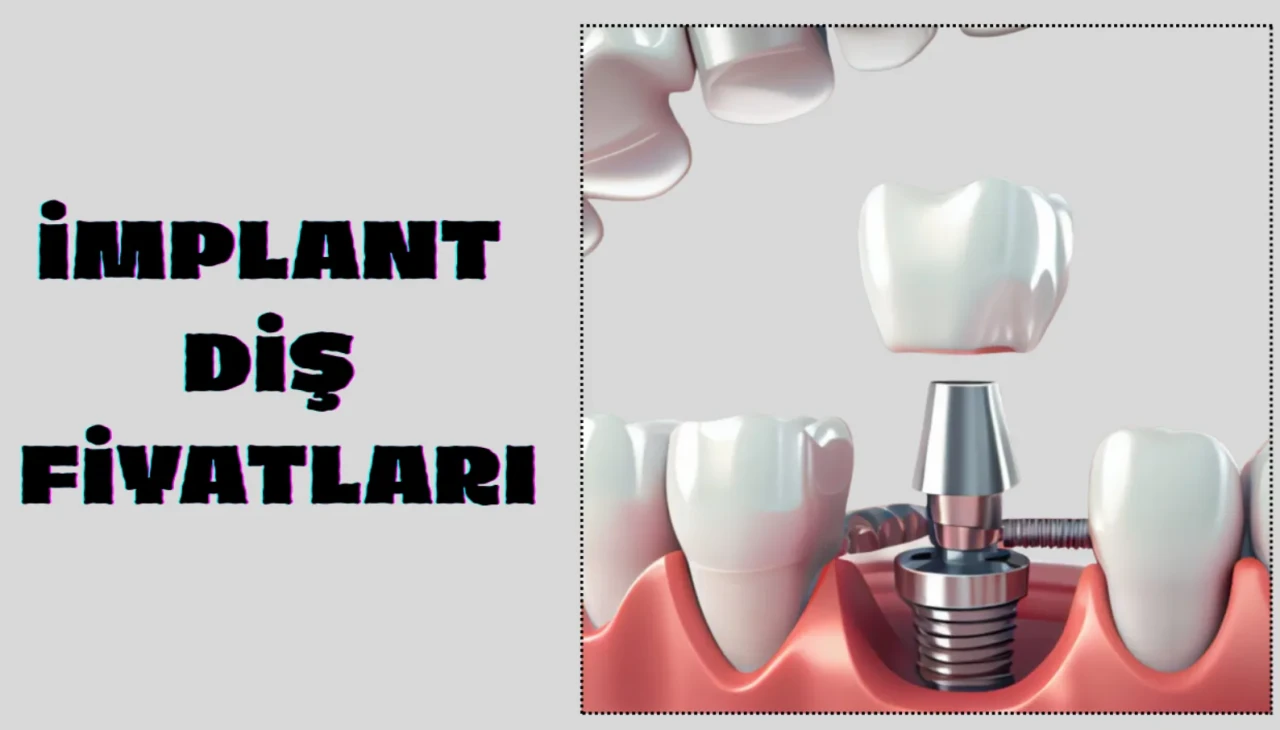 İmplant Diş Fiyatları 2025 Yılında Ne Kadar Oldu? Tedavi ve Maliyet