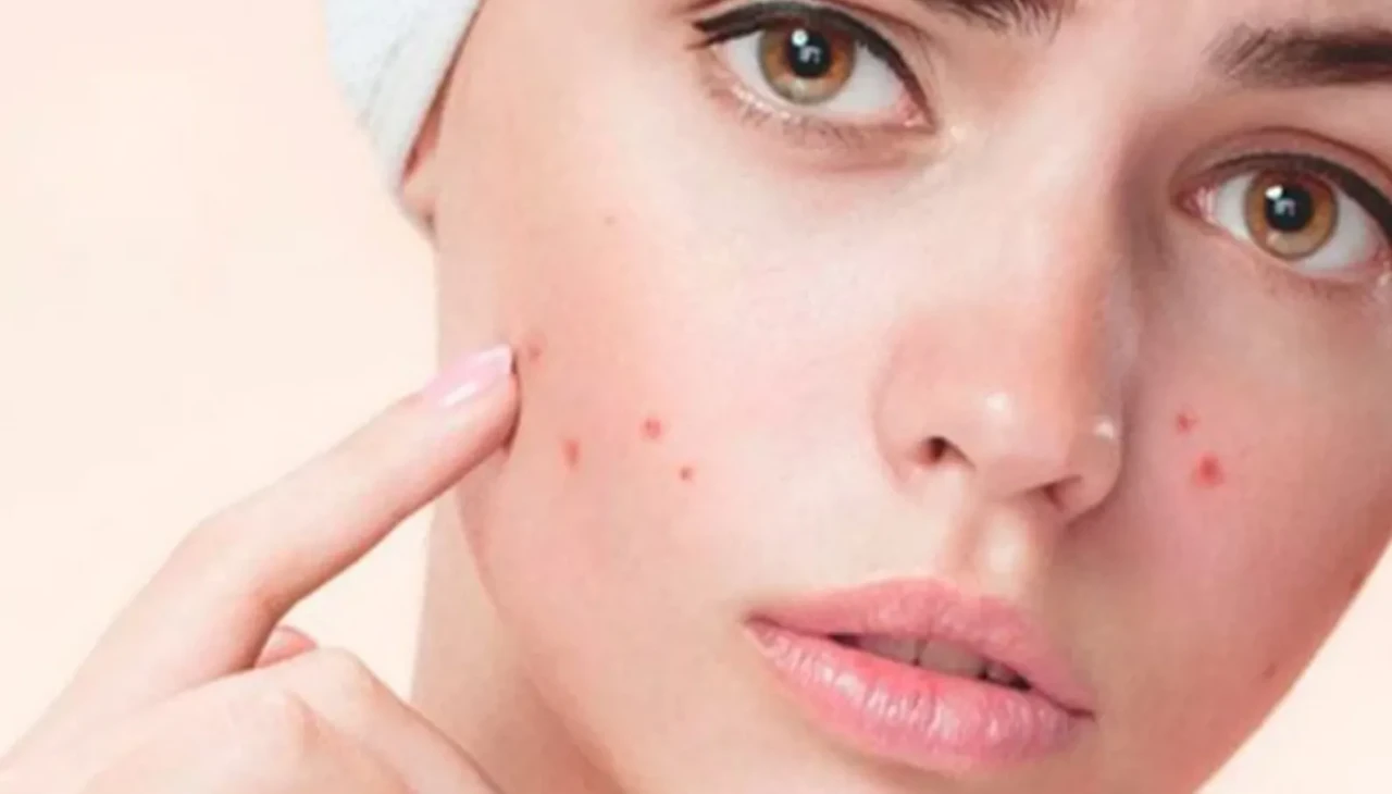 Akne: Nedenleri, türleri ve etkili çözüm yöntemleri