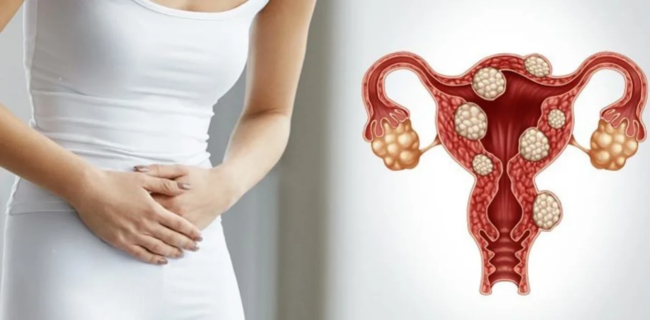 30 yaş sonrası her 3 kadından biri miyom sorunu ile karşılaşıyor: Ne yapmalı?