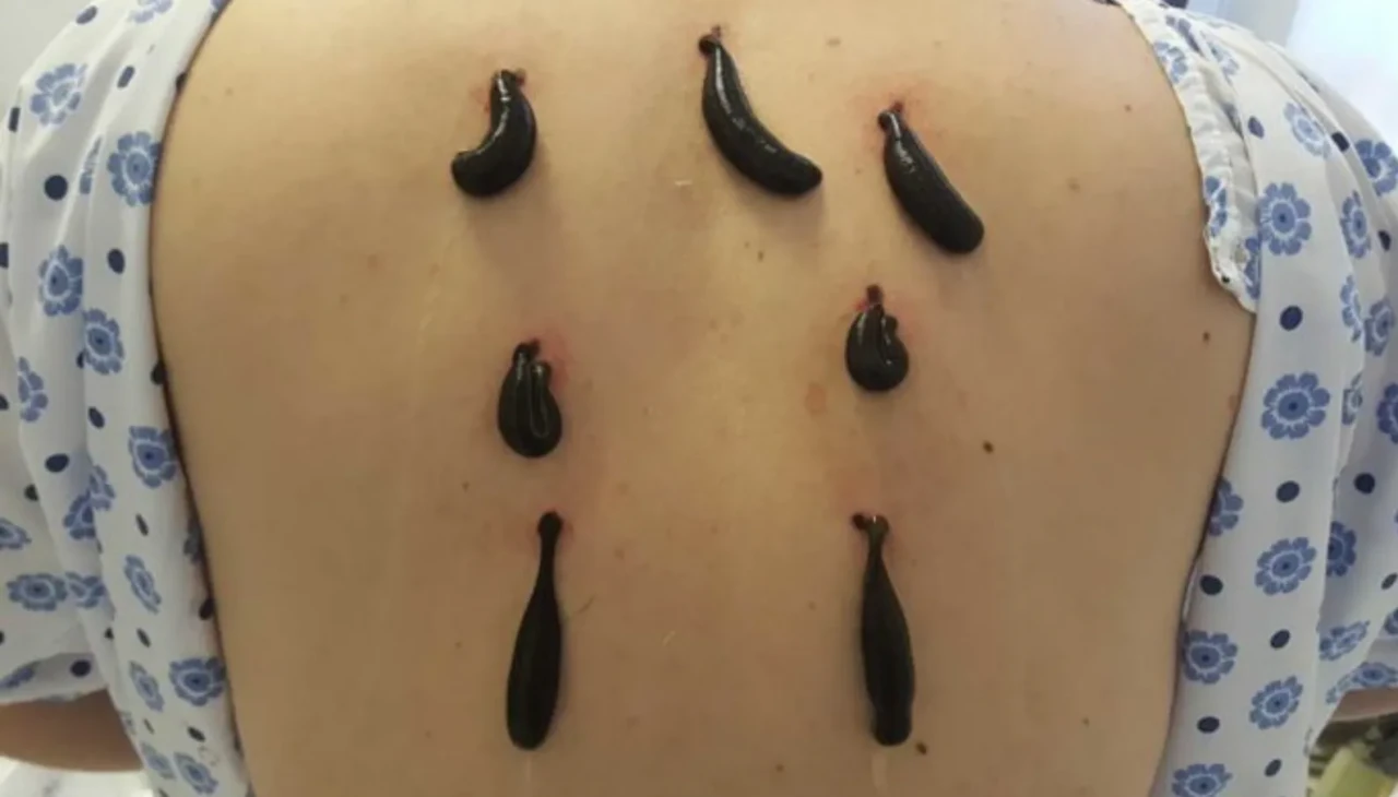 Doğa mucizesi mi, eski hurafe mi? Sülükler yeniden gündemde