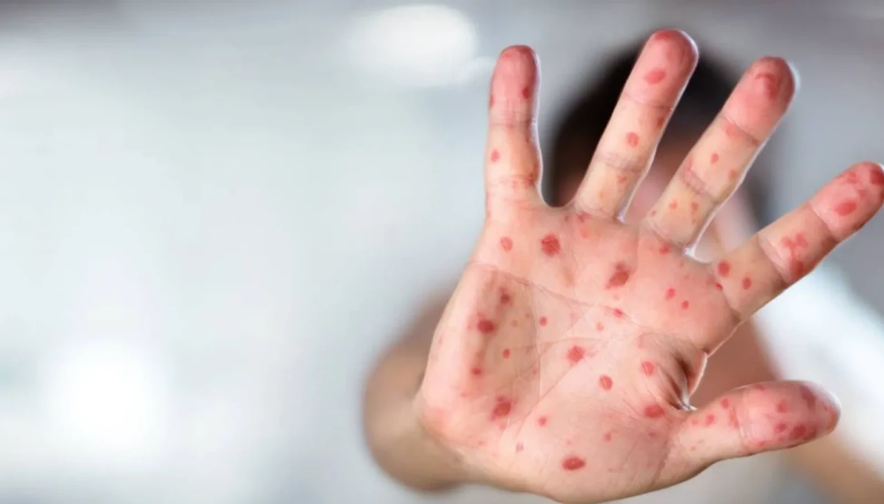 Çocuklarda yaz döküntüsü alarmı: Lekelere karşı uyarı