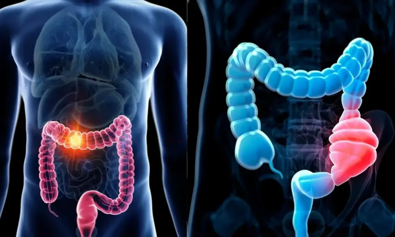 Gençlerde görülme sıklığı artan kolon kanserinde tarama yaşı düşüyor