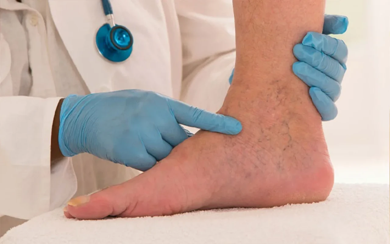 Bacak şişiyorsa dikkat: Hayati risk taşıyan hastalığın belirtisi olabilir