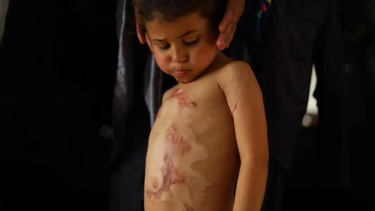 Katil İsrail’in 'tıbbi kısıtlaması' Gazze’yi vurdu: 3D yazıcı parçaları bile yasaklı listesinde!