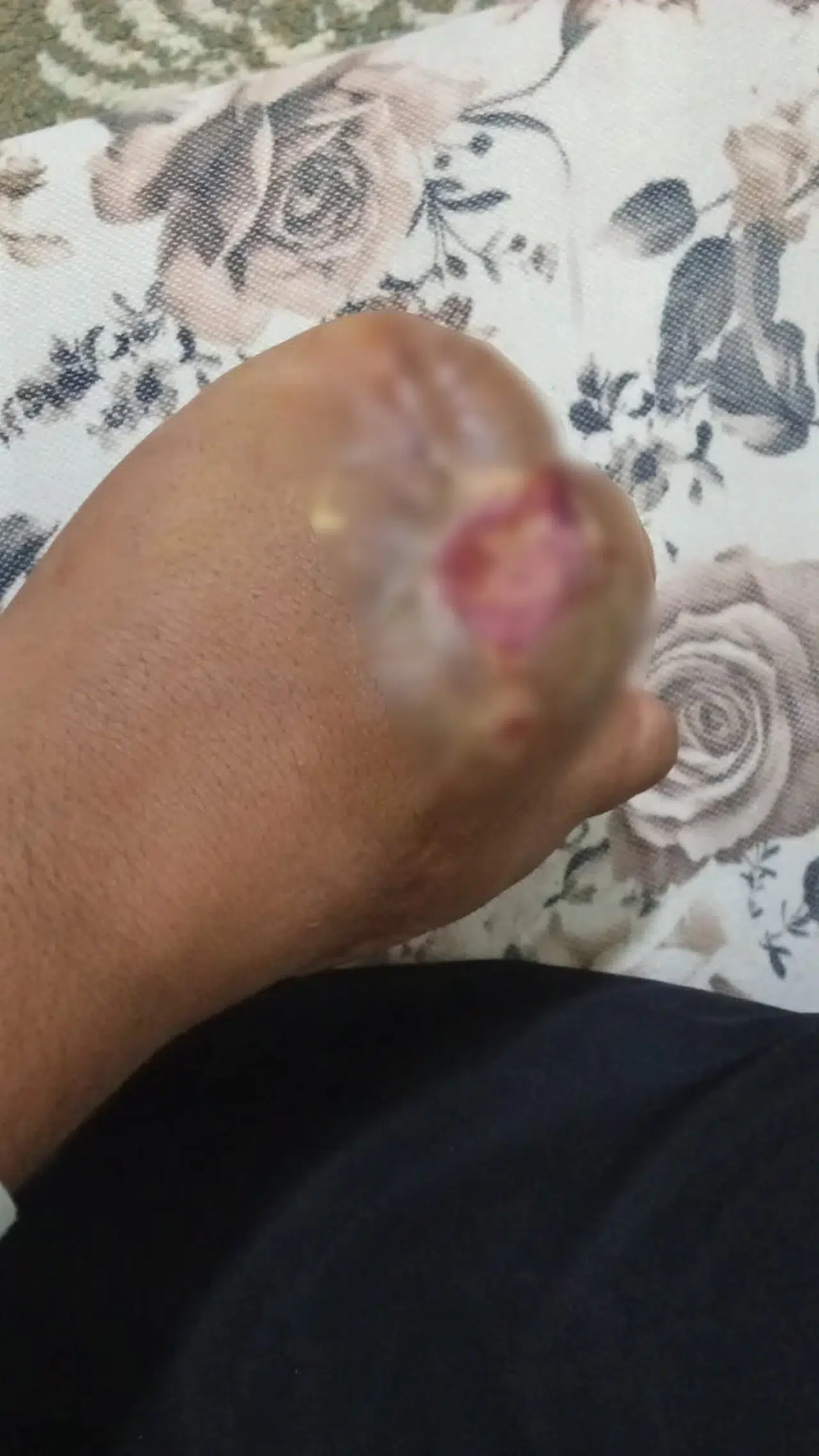 Kilis'te iş kazasında 5 parmağını kaybeden Mustafa Gez, 8 aydır iş arıyor