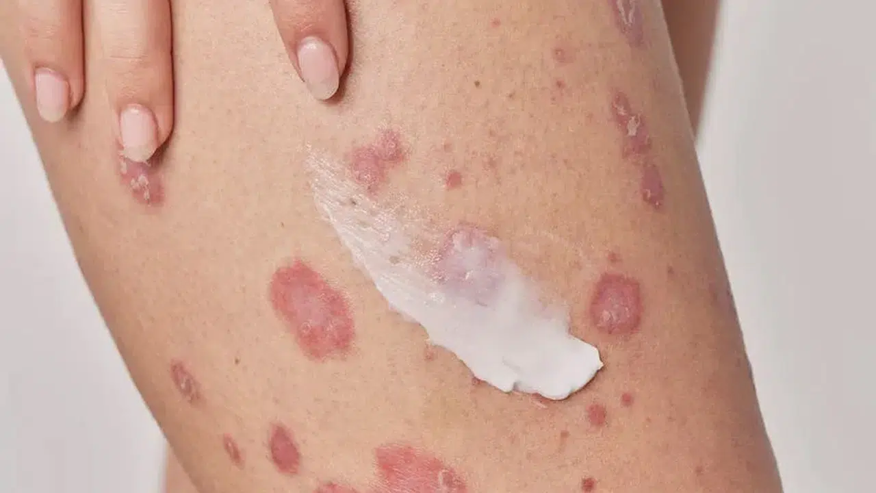 TSW Hastalığı Neden Ortaya Çıkar, Kalıcı mı, Topikal Steroid Withdrawal Belirtileri Neler?