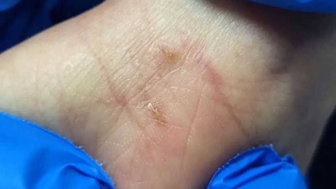 Sosyete uyuzu nasıl bulaşır, nedir, belirtileri neler, korunmak için neler yapılmalı, tedavisi ne?