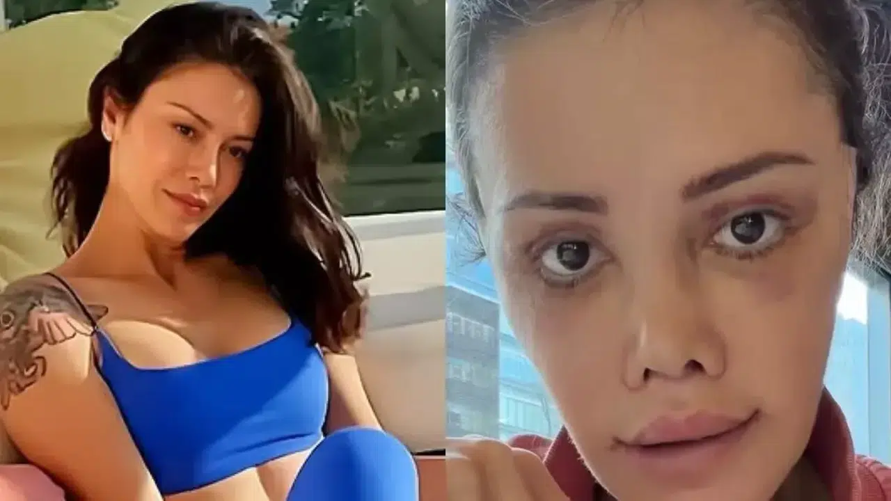 Didem Ceran’ın Son Hali Olay Oldu! “Yüz Nakli Mi Yaptırdı?” Sorusu Gündemde