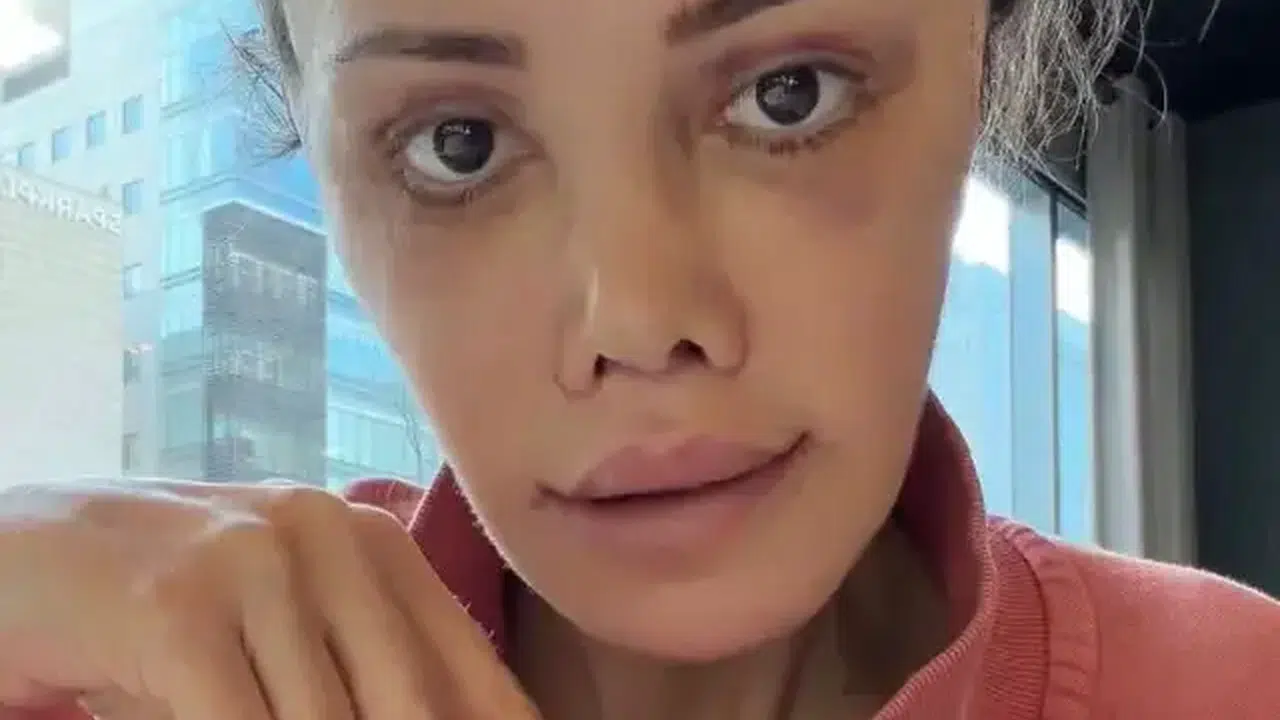 Güney Kore’de Yüz Estetiği Operasyonu Geçiren Didem Ceran Sosyal Medyayı Salladı