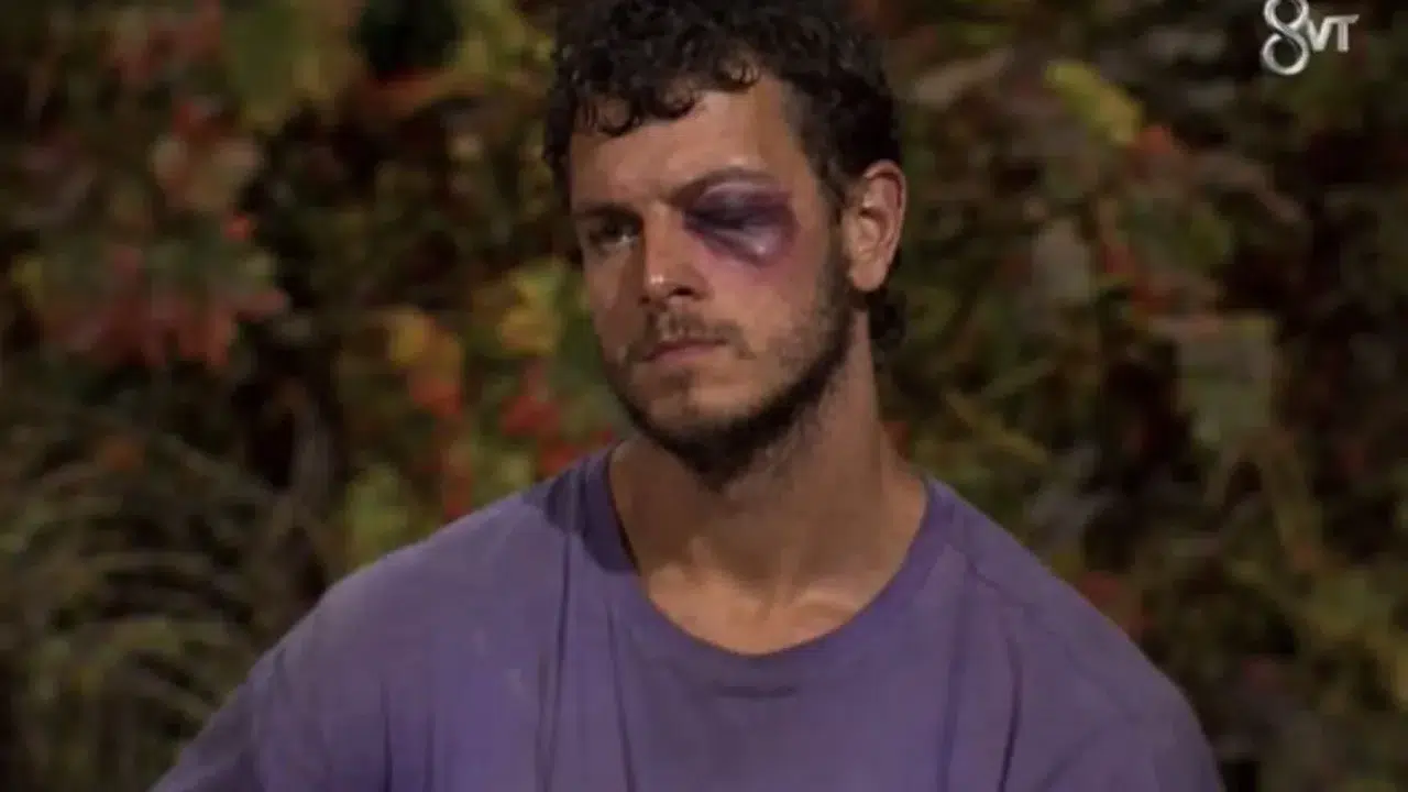 Survivor 2026 Engincan’ın Gözü Neden Morardı, Fotoğraf Gerçek mi Yoksa Yapay Zeka mı?