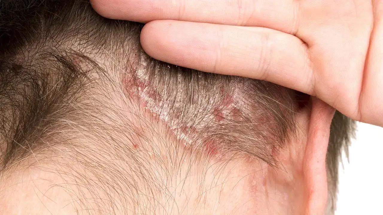 Saç Derisinde Görülen Belirtilerin Anlamı Ne, Saç Derisi Sorunları Sağlığı Etkiler mi, Nelere Dikkat Edilmeli?