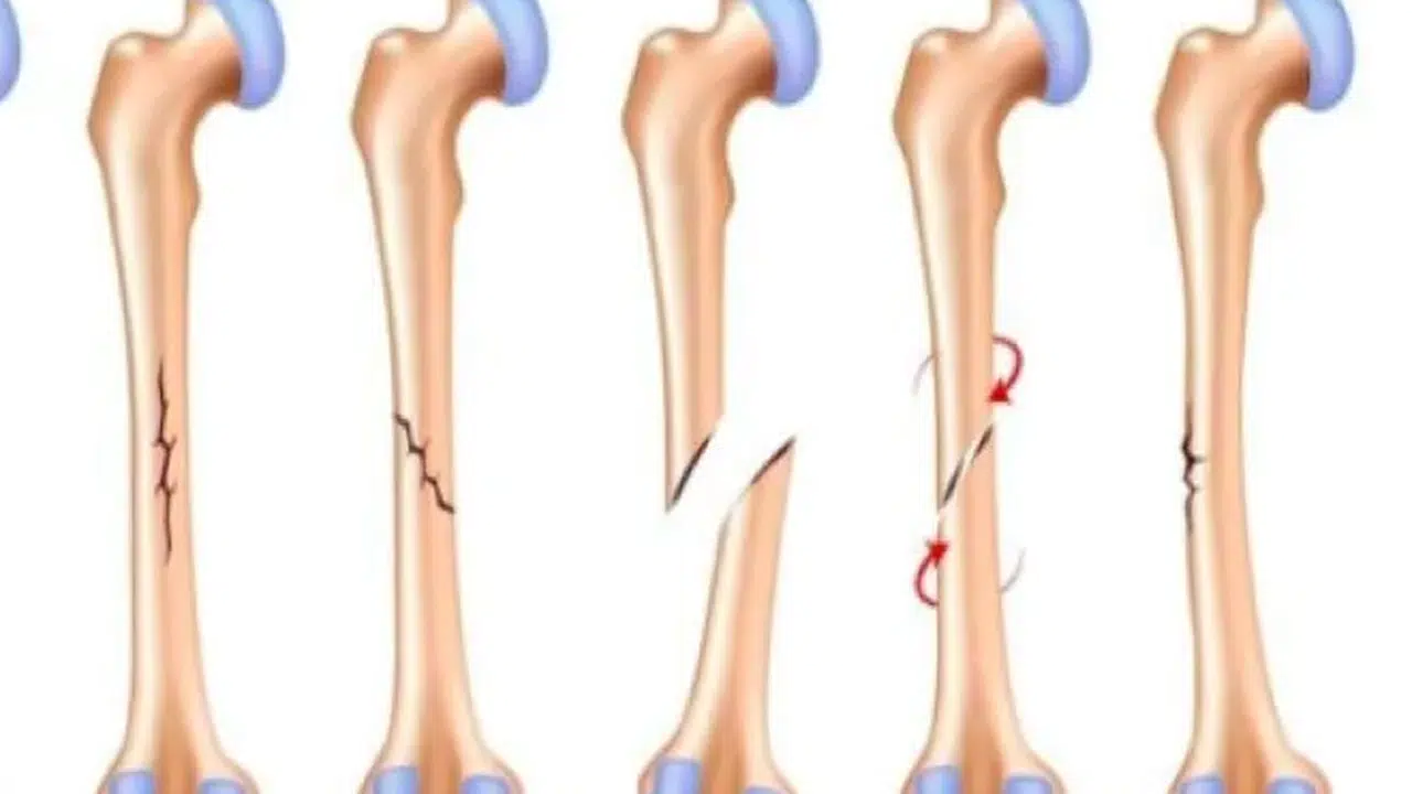 Uyluk neresi, uyluk kemiği vücudun hangi kısmında, ne işe yarar, neden önemlidir?
