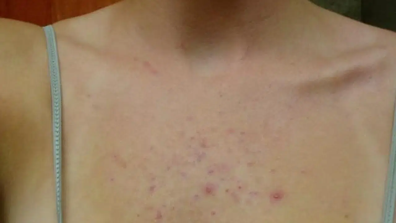 GÖĞÜS ETRAFINDA SİVİLCE NEDEN ÇIKAR! Nasıl Geçer ve Hangi Tedavi Yöntemleri Etkili?