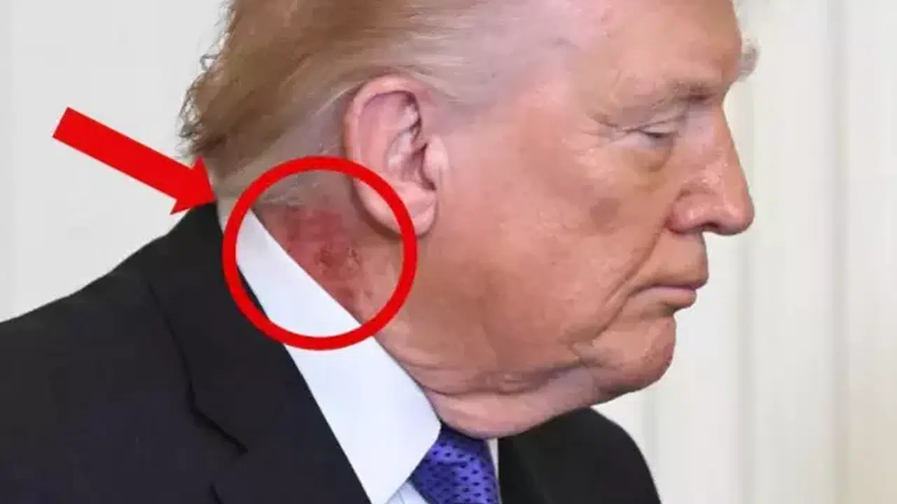 Donald Trump’ın boynundaki kırmızı iz ne, hasta mı, sağlık durumu nasıl?