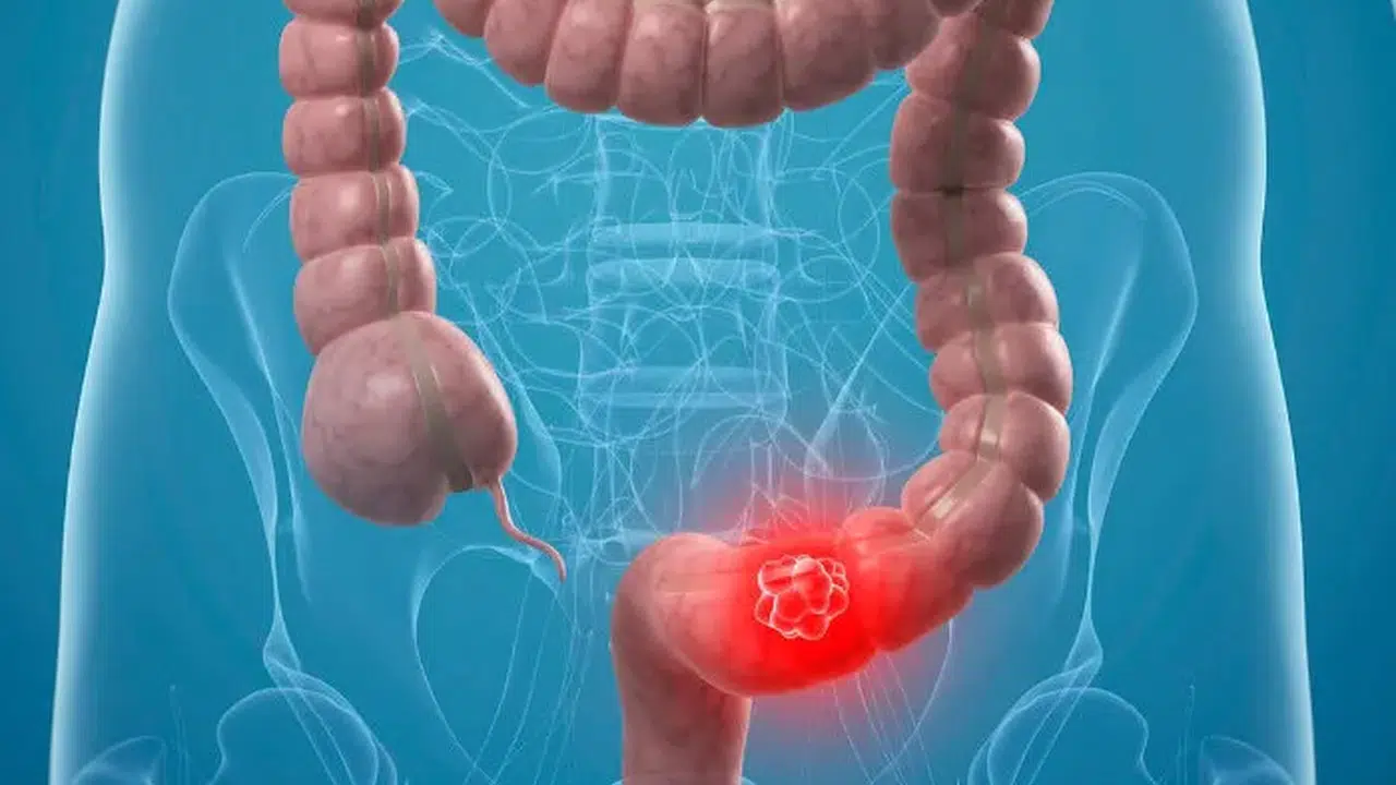 AB KAN GRUBUNDA KOLON KANSERİ RİSKİ DAHA MI YÜKSEK? AB Grubu Neden Daha Riskli?