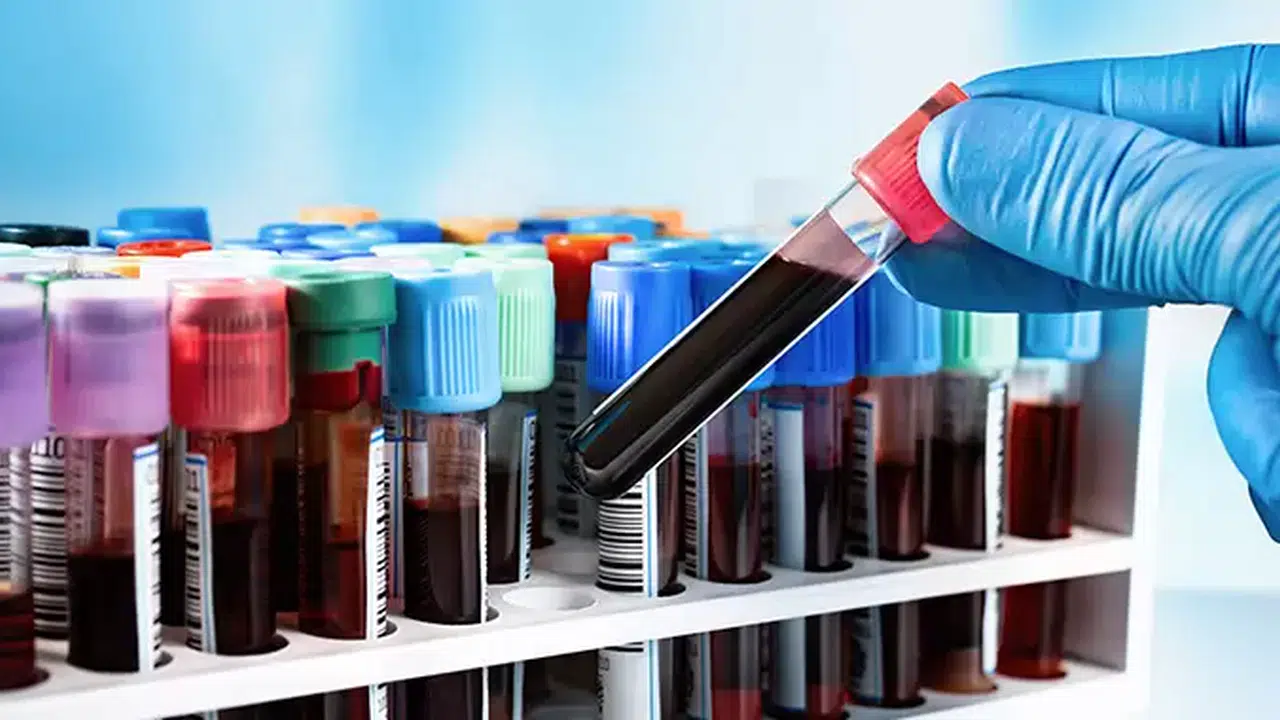 KAN TAHLİLLERİ ANLAMLARI NELERDİR? Kan Tahlili Nasıl Yapılır, Aç Karnına mı Yapılır, Değerleri ve Sonuçları Nasıl Yorumlanır?