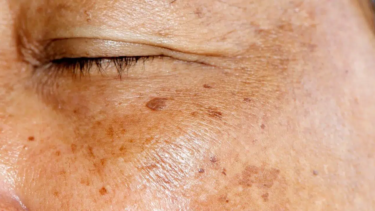 YÜZDE KAHVERENGİ BENLER NEDEN ÇIKAR? Nasıl geçer, etkili yöntemler, doğal çözümler ve tedavi seçenekleri neler?