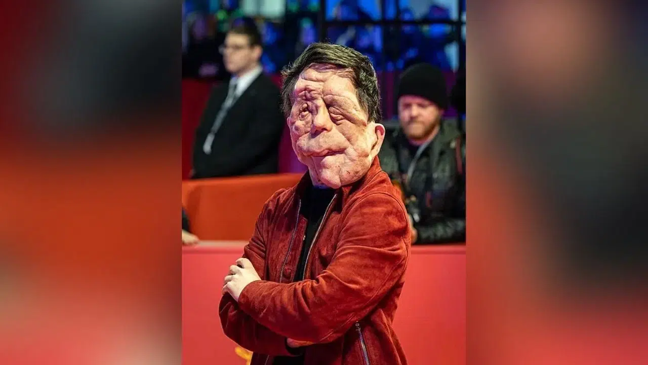 ADAM PEARSON KİMDİR, HASTALIĞI NE? Yüzüne ne oldu, filmleri ve hayatı