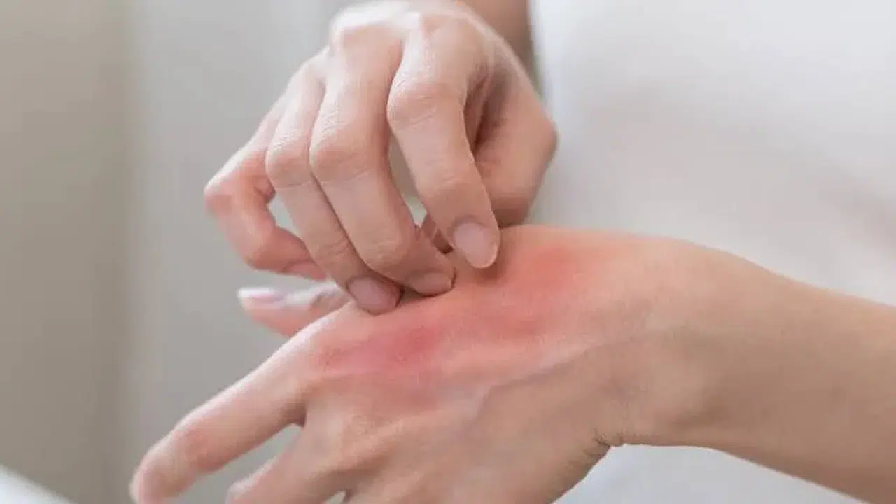 ALERJİ SEZONU BAŞLADI MI! Polenler Ne Zaman Artar, Bahar Alerjisi Hangi Aylarda Görülür?