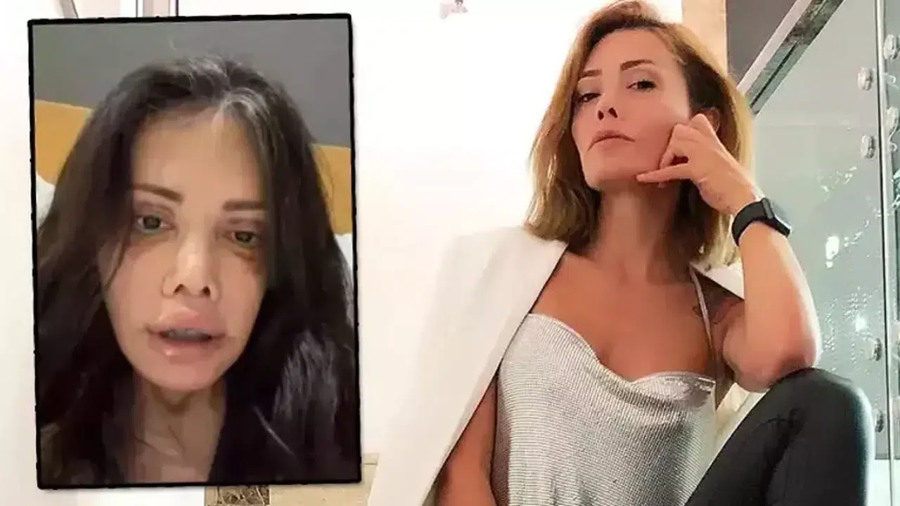 DİDEM CERAN’IN YÜZ NAKLİ İDDİASI GERÇEK Mİ!  Güney Kore’deki Estetik Operasyonun Detayları
