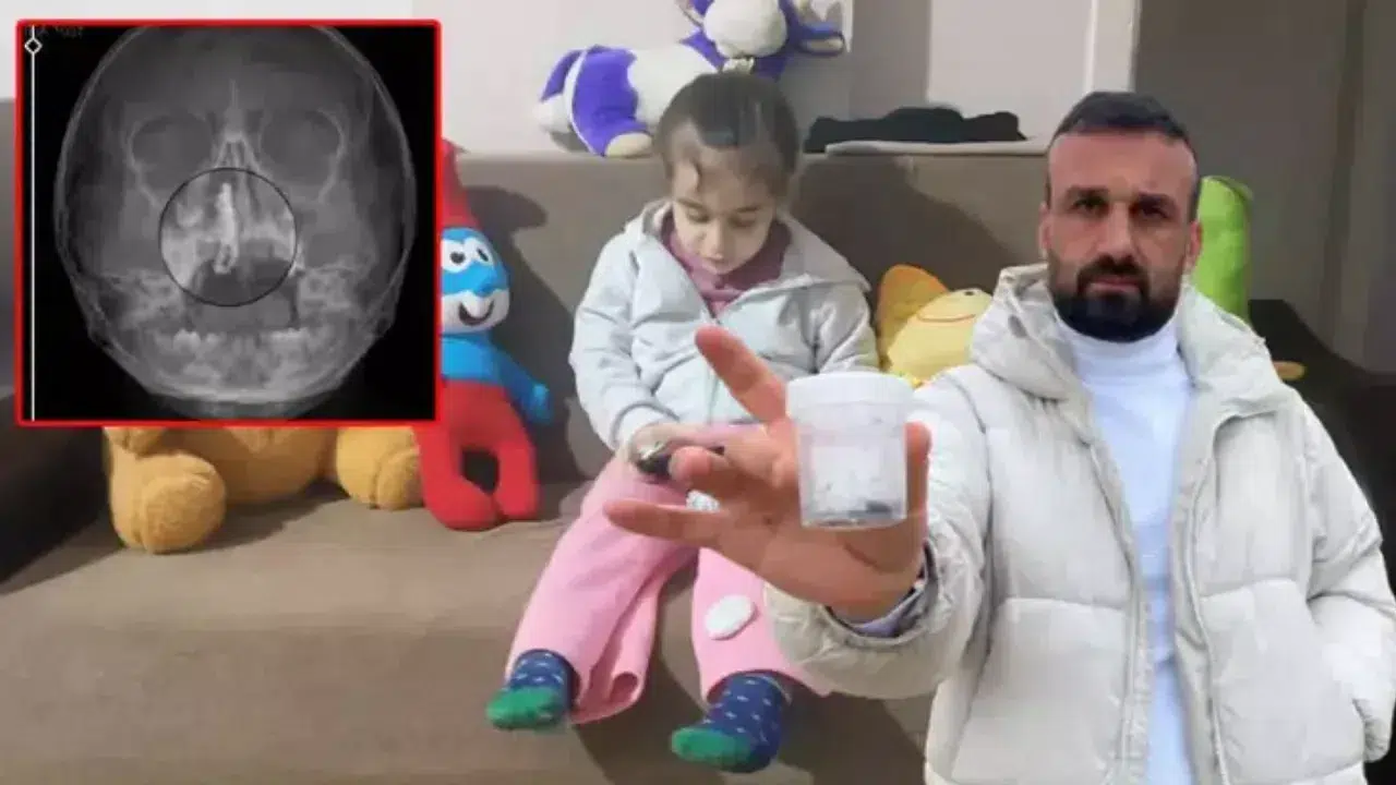 Rize’de 5 Yaşındaki Çocuğun Burnundan 2 Yıllık Metal Cisim Çıkarıldı!