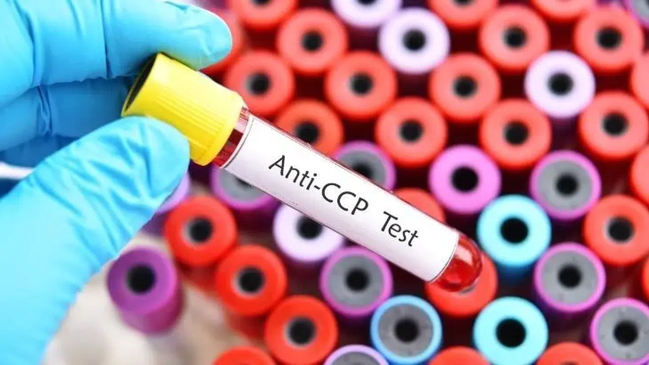 CCP Testi Nedir, Kimlere Yapılır, Romatoid Artrit ile Bağlantısı Nedir, Negatif Sonuç Ne Anlama Gelir?