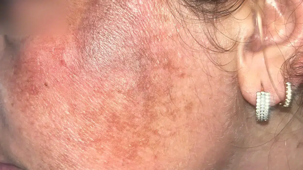 Adana’da cilt bakımı sonrası yüzünde 2. derece yanık oluşan kadın şikayetçi oldu!