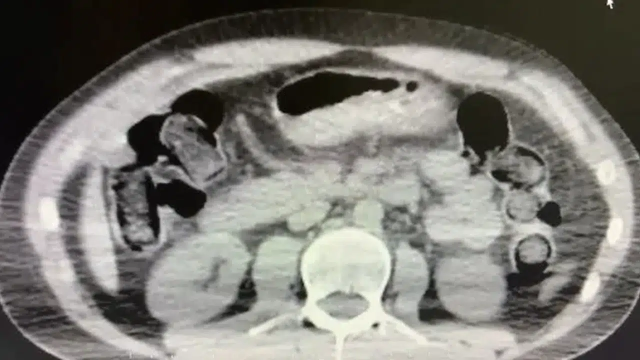 Vücutlarını kargo olarak kullandılar! Mideleri zehir deposu çıktı...