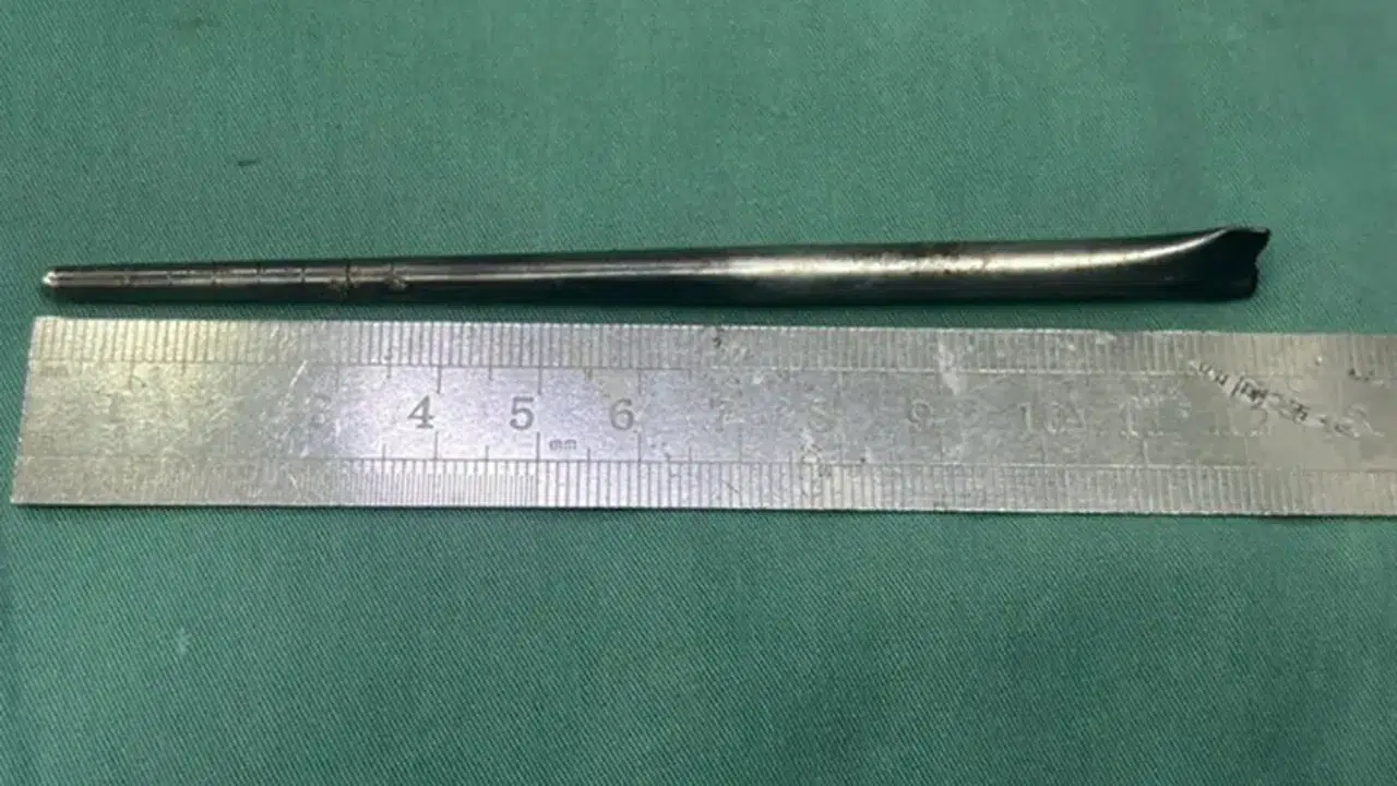 Röntgenine bakan doktorlar gözlerine inanamadı... Boğazından çıkan şey 8 yıllıkmış!