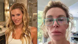 Brandi Glanville'in yüzüne ne oldu? Hastalığı nedir, yardım kampanyası neden başladı?