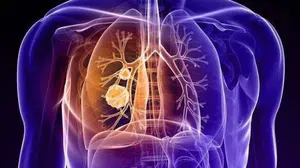 Akciğer kanserinde kritik risk: Sigara