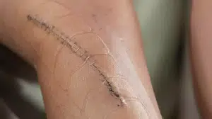 Diz ameliyatı geçirdi kendi dilini unuttu: Anesteziden uyanınca kendini ABD'de sandı!