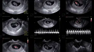 5 Haftalık Gebelikte Kese Görüntüsü Normal mi, Bebek Kaç mm ve Kaç Aylık?