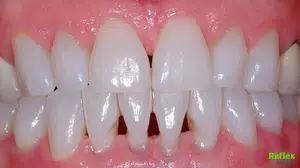 Fırçalarken Kanıyorsa Dikkat: Diş Eti Çekilmesi Sessizce İlerliyor