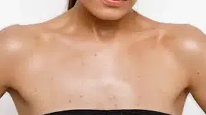 GÖĞÜS ETRAFINDA SİVİLCE! Neden olur,