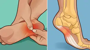 Topuk dikenine hangi krem iyi gelir? Eczanedeki en etkili kremler hangileridir, nasıl kullanılır?