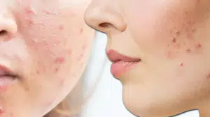 Elma sirkesi cilde faydalı mı? Maden suyu sivilcelere iyi gelir mi, akne nasıl geçer, ne işe yarar?